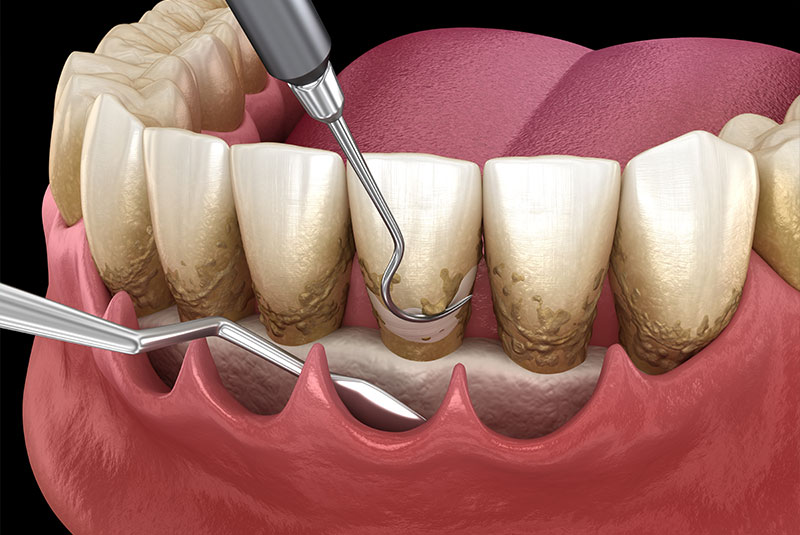 illustration of perio procedure