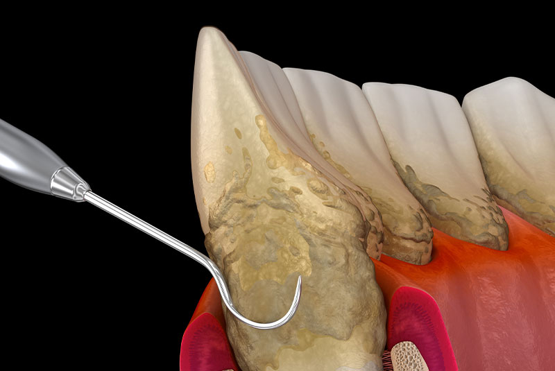 illustration of perio procedure