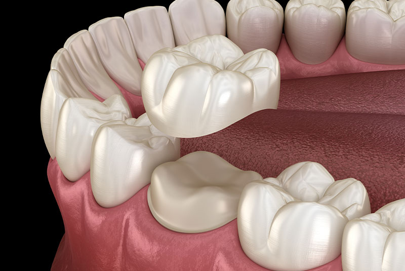 illustration of dental crown