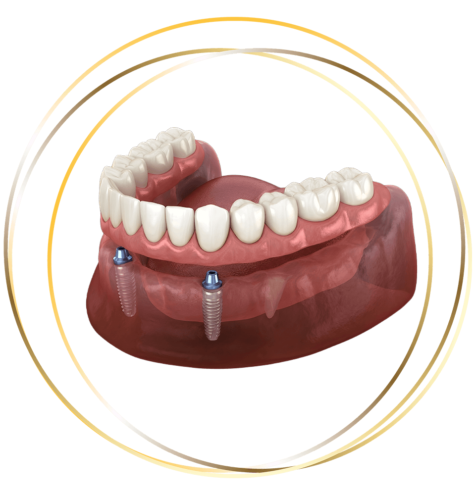 dentures within frame