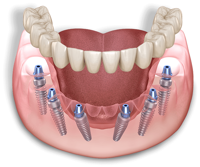 illustration of full arch dental model