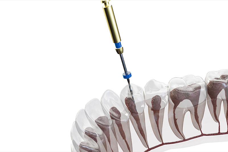 close up of dental root canal treatment