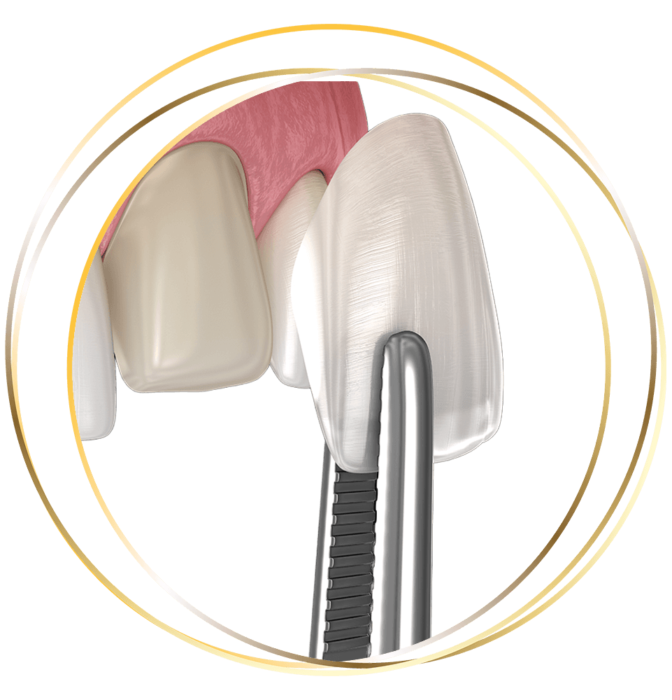 close up illustration of dental veneer